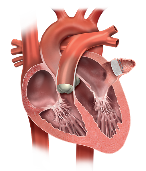 Ilustracja serca z urządzeniem metodą zamknięcia uszka lewego przedsionka