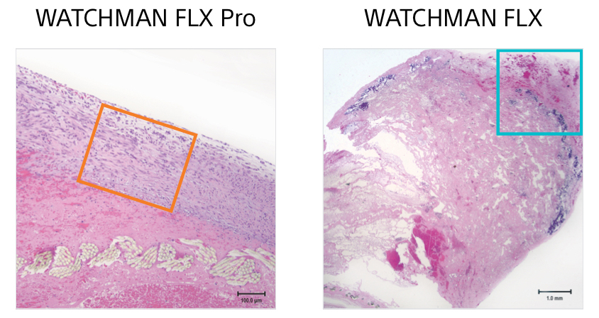 Thrombus comparision images between WATCHMAN FLX Pro and WATCHMAN FLX.