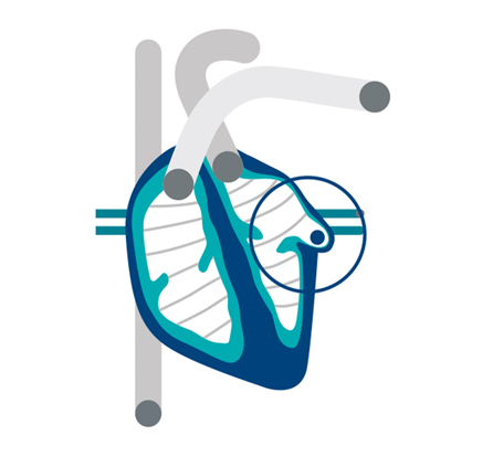 Diagram of blood clot in left atrial appendage.