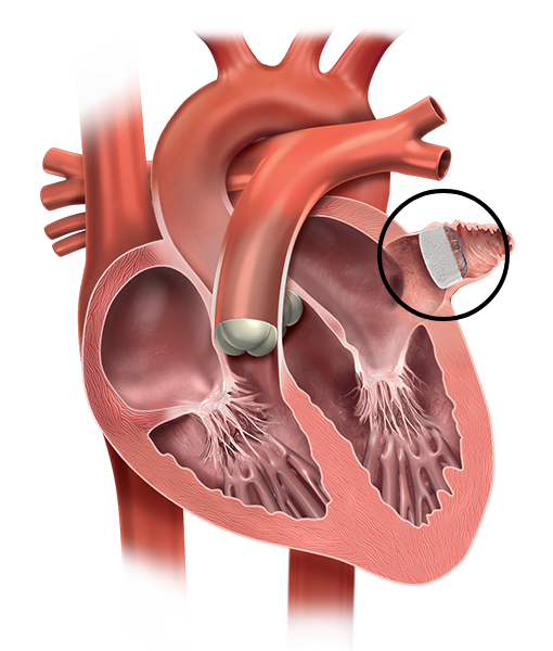 Vorhofohr-Verschlusssystem (LAAC)