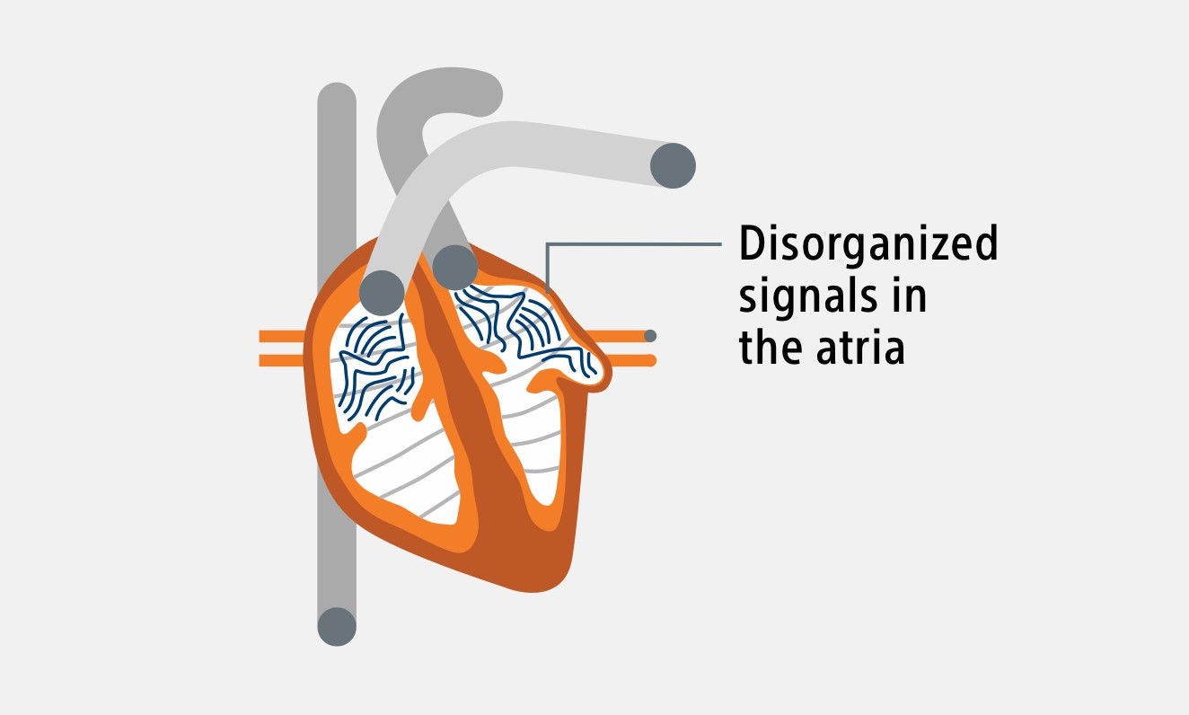 A graphic of a heart with disorganized signals in the atria.