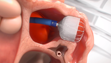 Das WATCHMAN FLX Pro-Implantat wird in das LAA eingebracht und appliziert.