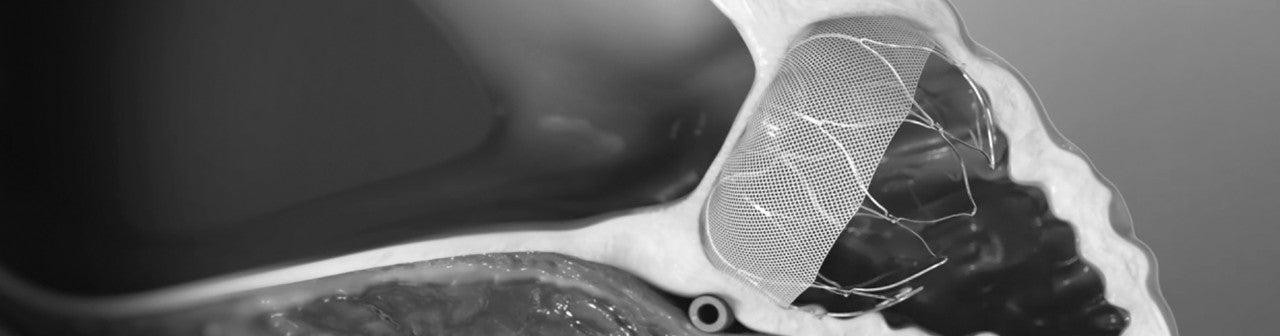 An interior view of a human heart with the WATCHMAN device implanted