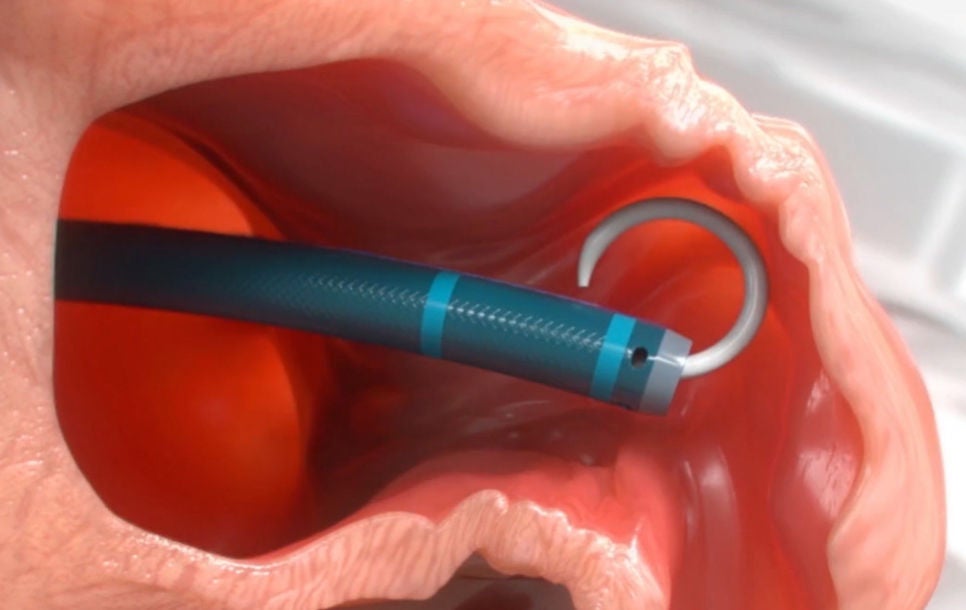 Rendering of guidewire and vessel dilator entering the heart of patient.