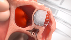 Das Herzgewebe wächst über das WATCHMAN-Implantat.