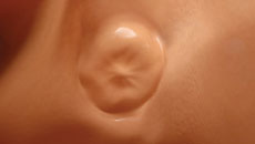 Das WATCHMAN Implantat ist vollständig endothelialisiert.