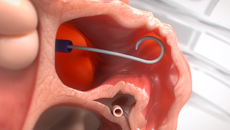 Die Zugangsschleuse wird zum linken Vorhof und von dort zum LAA vorgeschoben.