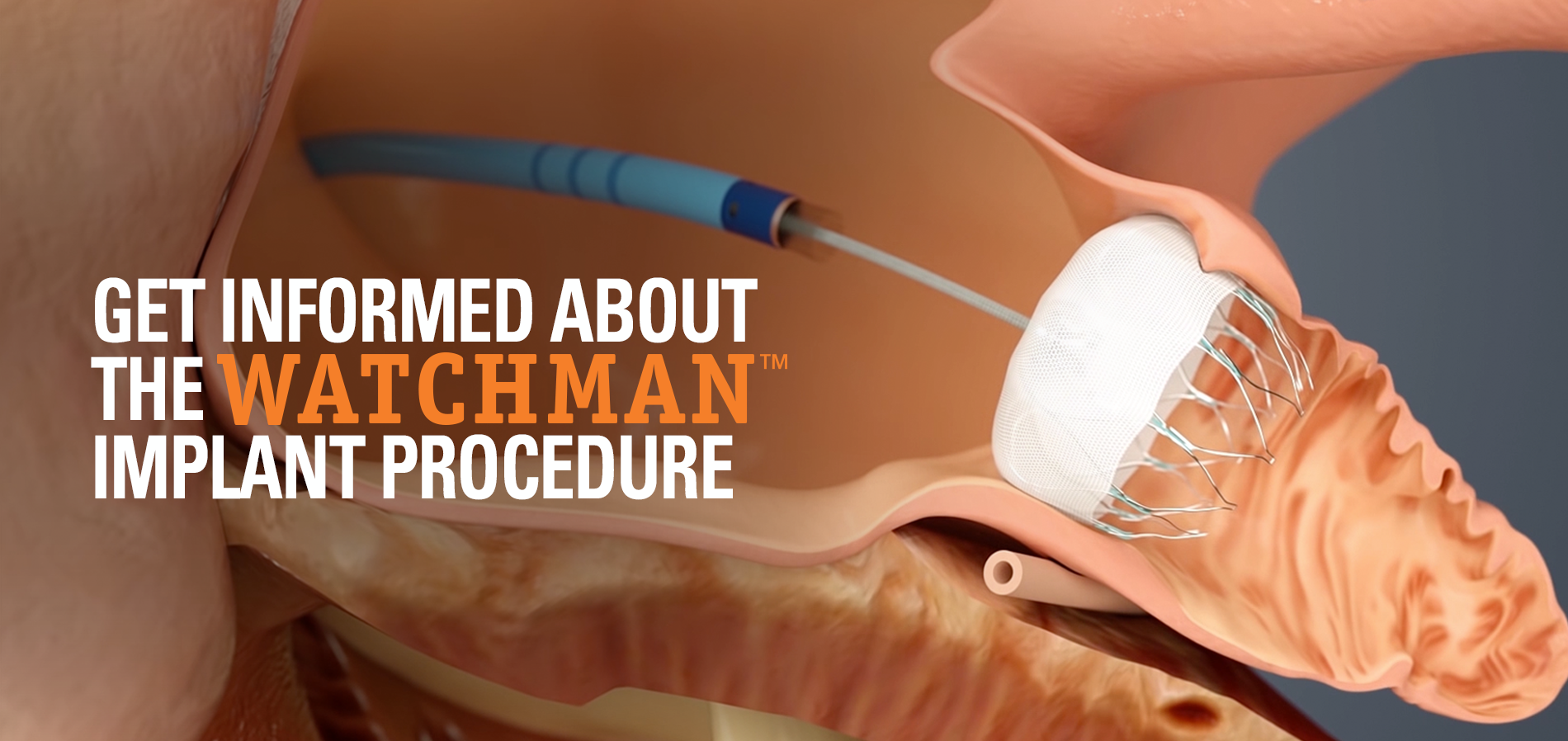 The Implant Procedure  WATCHMAN Device