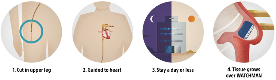WATCHMAN procedure steps with illustrations.