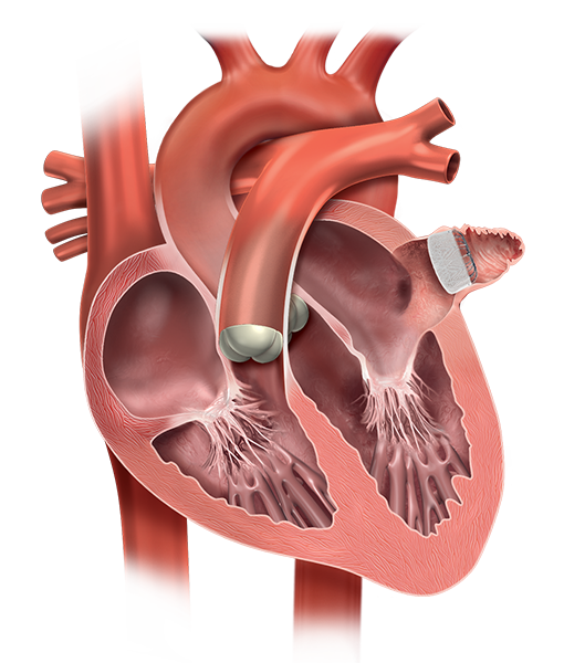 Intervención para la implantación del dispositivo WATCHMAN FLX<sup>TM</sup>