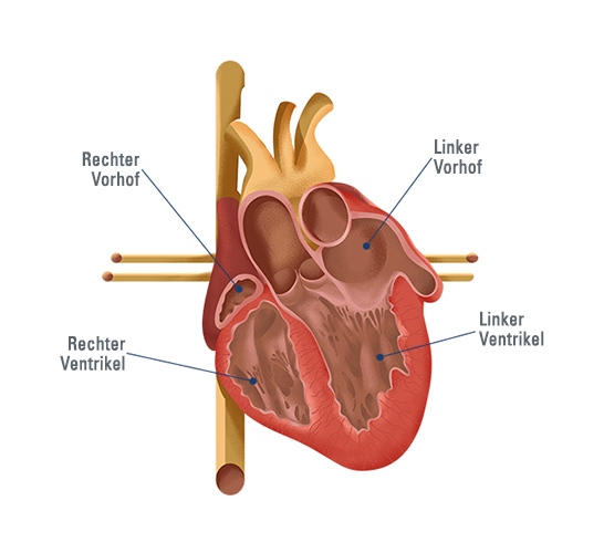 Wie wirkt sich Vorhofflimmern auf das Herz aus?