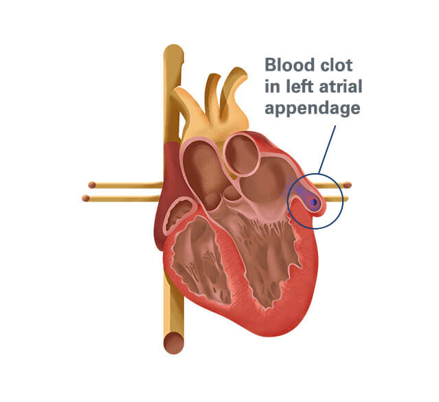 blood clot in left atrial appendage illustration