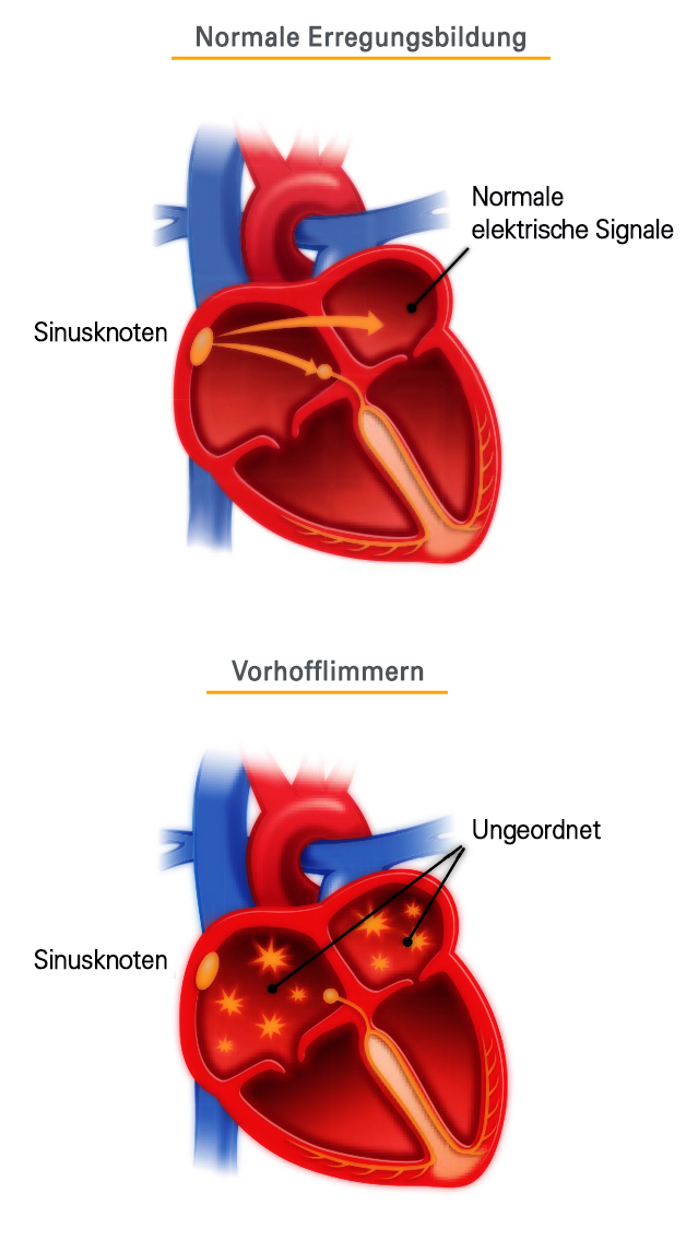 Was verbindet Vorhofflimmern und Schlaganfälle?