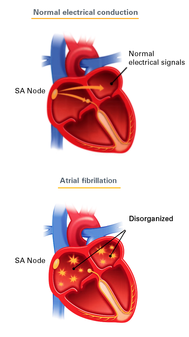 Normal electrical conduction and Atrial Fibrillation