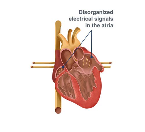 heart image showing disorganized electrical signals in the atria