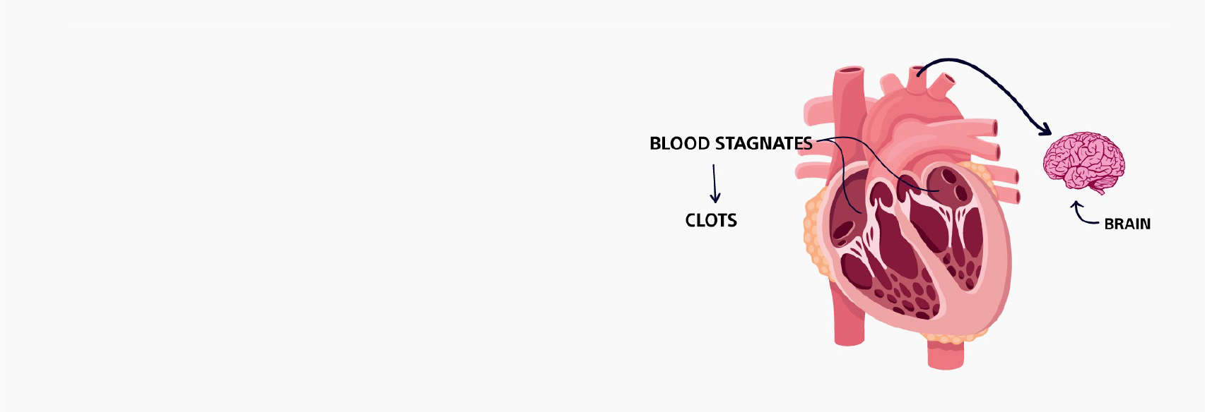 The risk of stroke is 5x higher in patients with AF*