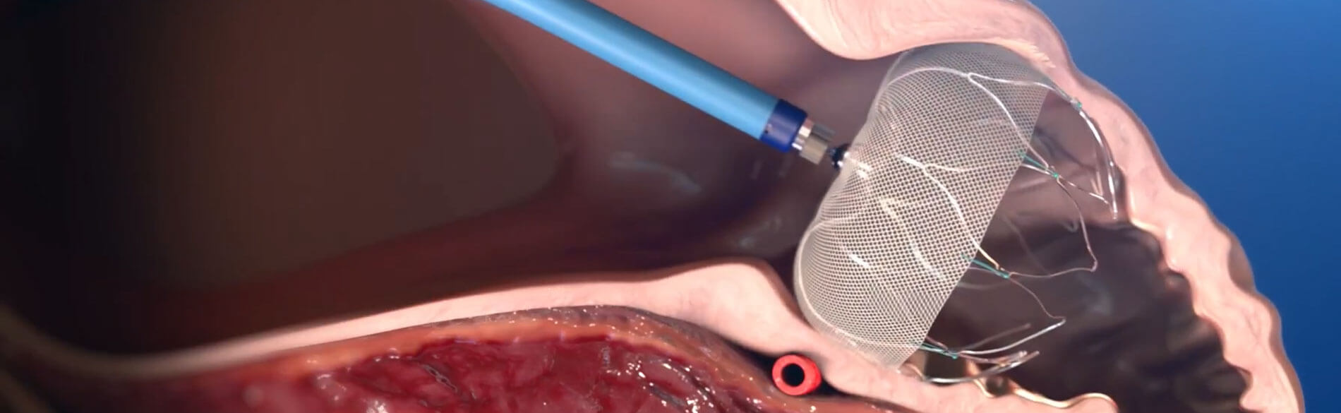 WATCHMAN Device implanted