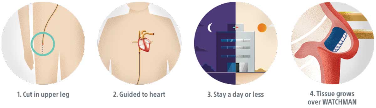 WATCHMAN procedure steps with illustrations.