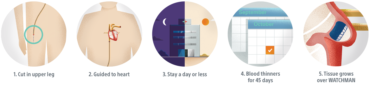 WATCHMAN procedure steps illustration