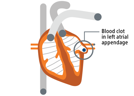 A heart illustration showing a blood clot in the left atrial appendage.
