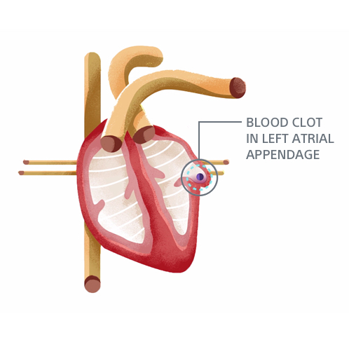 blood clot in left atrial appendage illustration