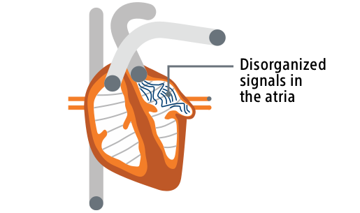 A heart illustration showing disorganized signals in the atria.