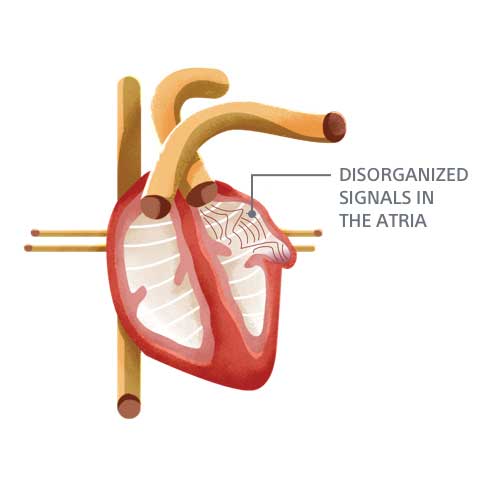 heart image showing disorganized electrical signals in the atria