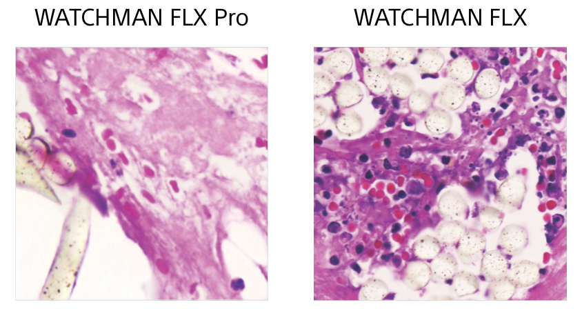 Inflammation comparision images between WATCHMAN FLX Pro and WATCHMAN FLX.