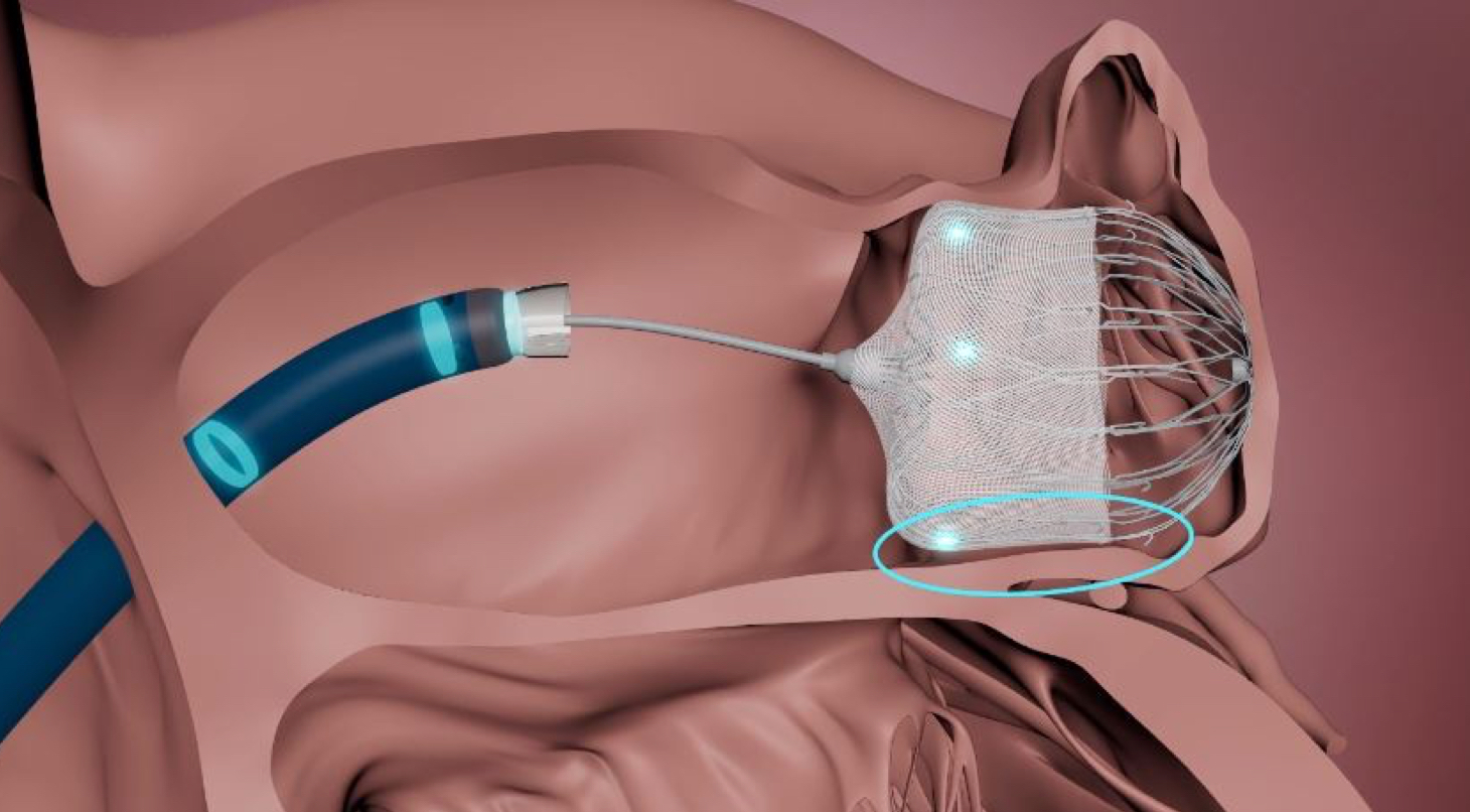 WATCHMAN TruSteer™ Access System