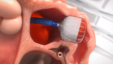 The WATCHMAN FLX Pro is deployed and released in the LAA.