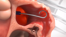 The access sheath advances to the left atrium and towards the LAA.