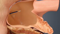 The heart shows how the interatrial septum is crossed with a standard transseptal access system.