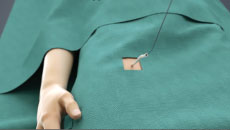 The access point for the WATCHMAN LAAC procedure.