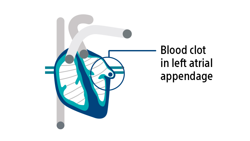 Diagram of blood clot in left atrial appendage.