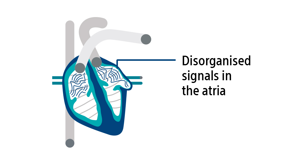 Diagram of disorganized signals in the atria.