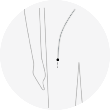 WATCHMAN Implant procedure step 1