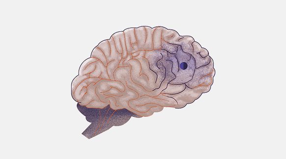 A graphic of a human brain with a stroke signal depicted in it.