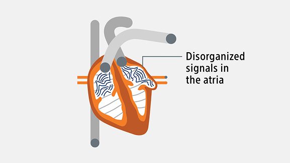 A graphic of a heart with disorganized signals in the atria.