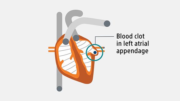 A graphic of a heart with a blood clot in the left atrial appendage.